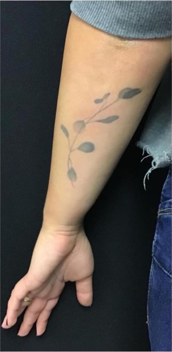 Before: Tattoo removal, arm