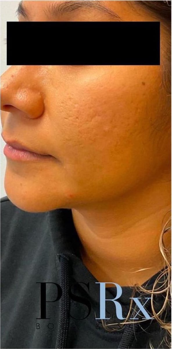 After: Scars, cheeks