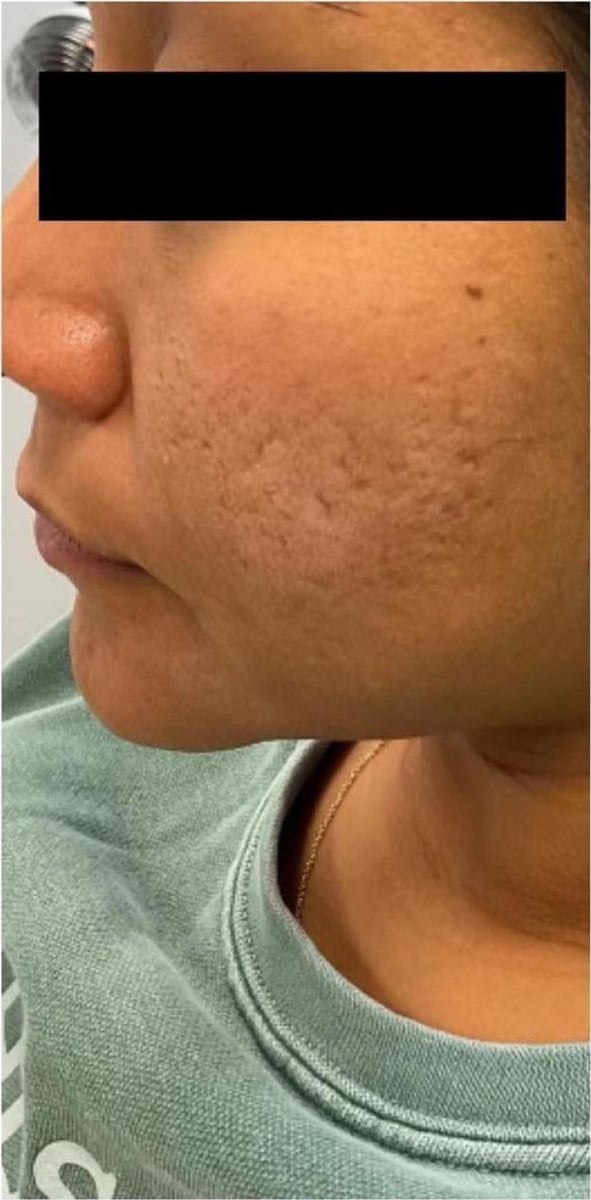 Before: Scars, cheeks