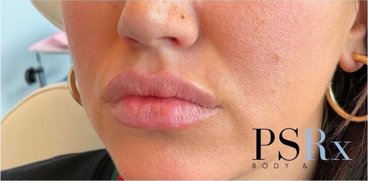 After: Filler, lips