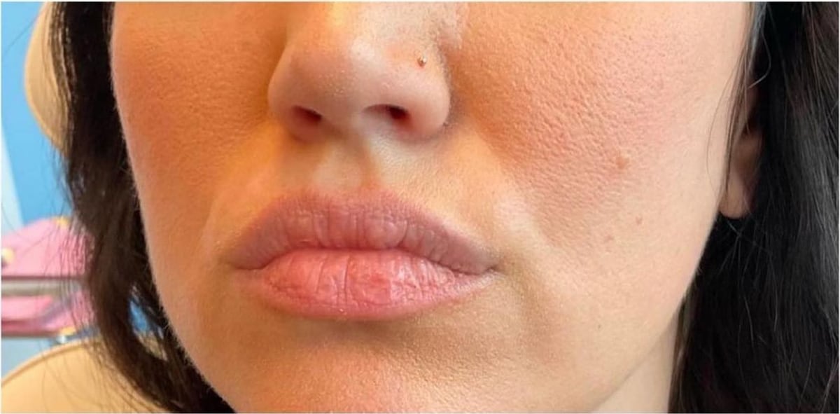 Before: Filler, lips
