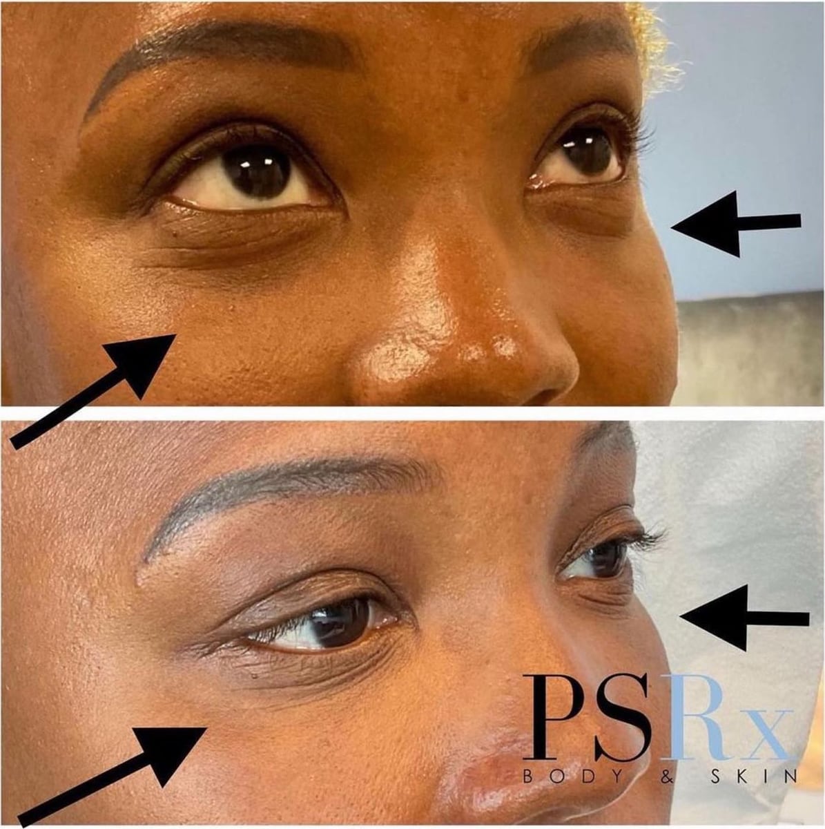 Before and after: Filler, under the eyes