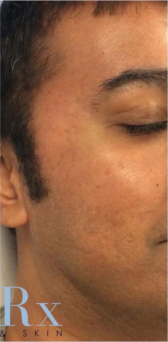 After: Scars, cheeks