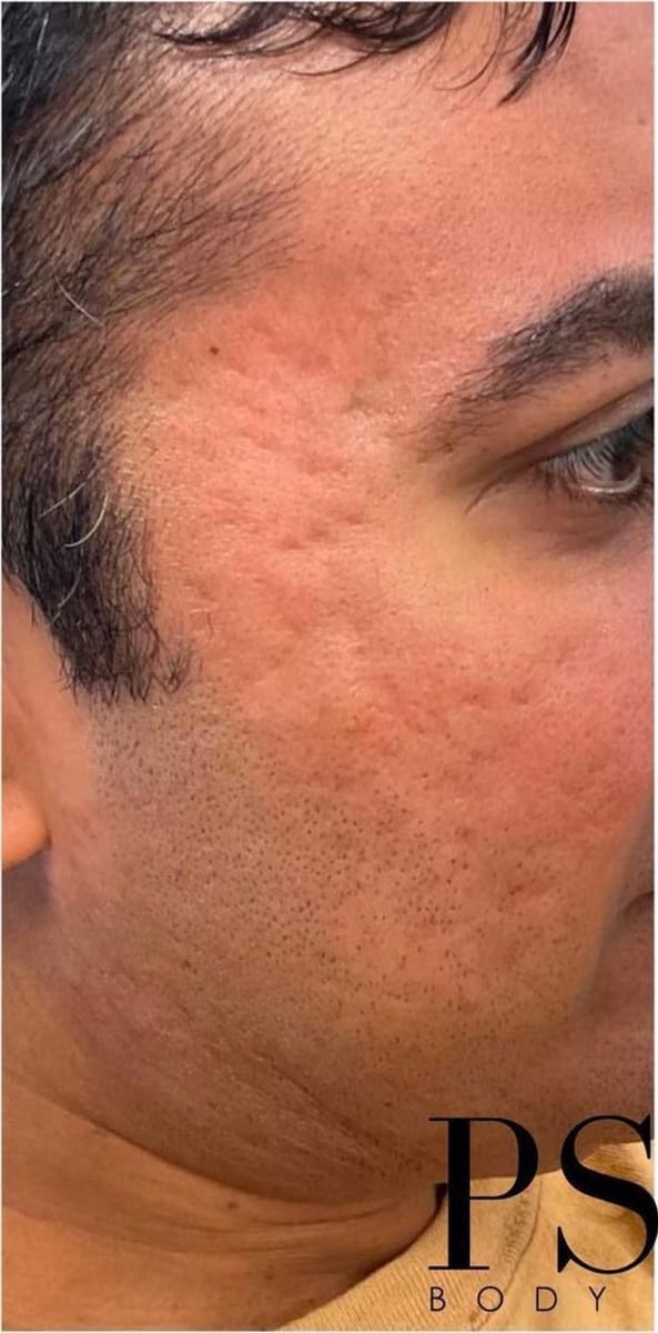 Before: Scars, cheeks