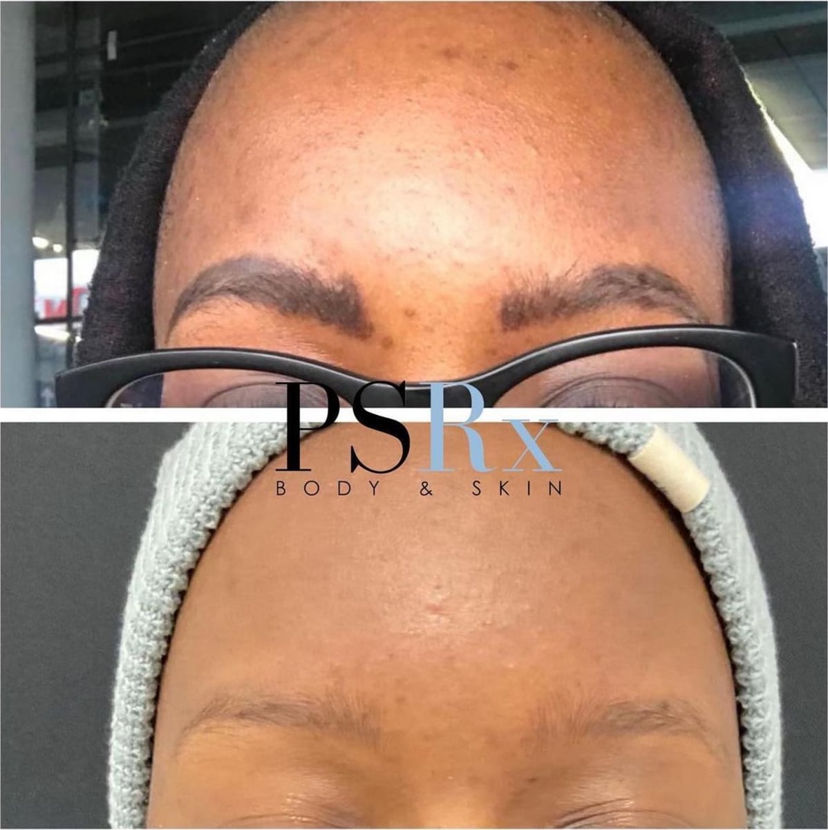 Before and after: Tattoo removal, brows