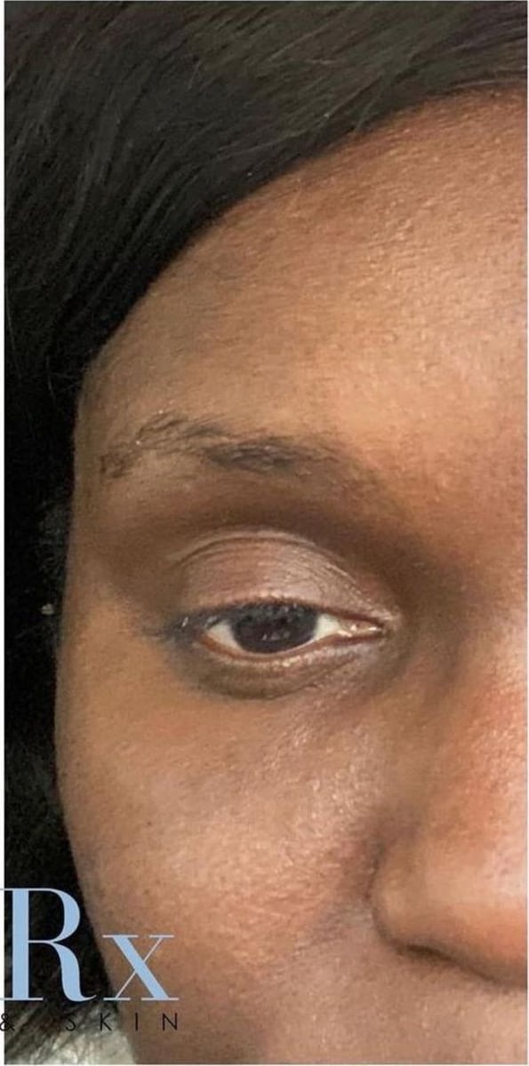 After: Filler, under the eyes