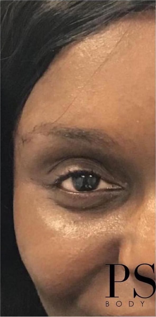 Before: Filler, under the eyes