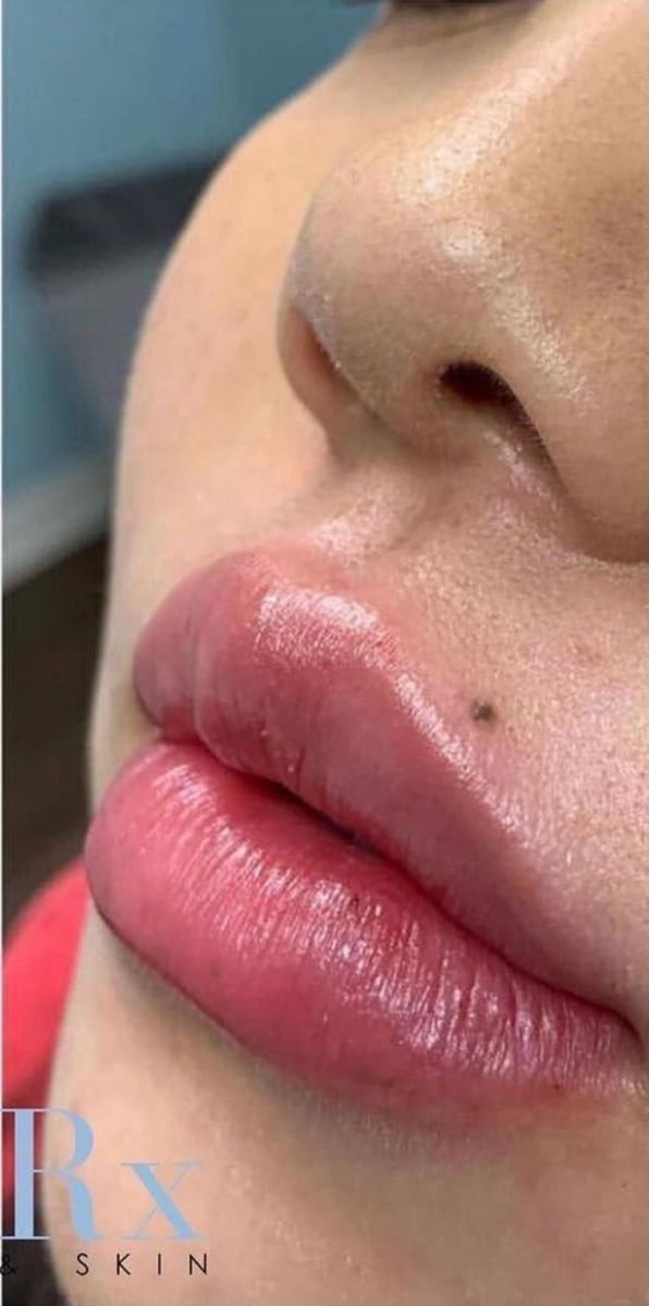 After: Filler, lips