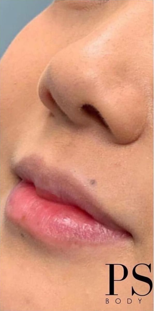 Before: Filler, lips