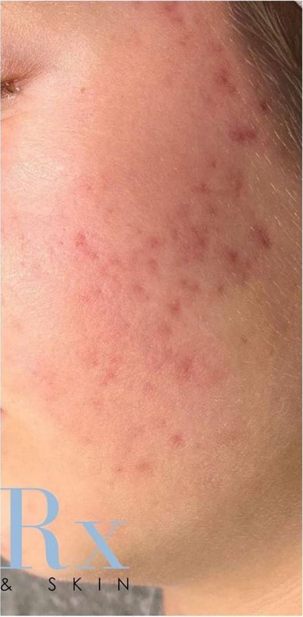 After: Acne, cheeks