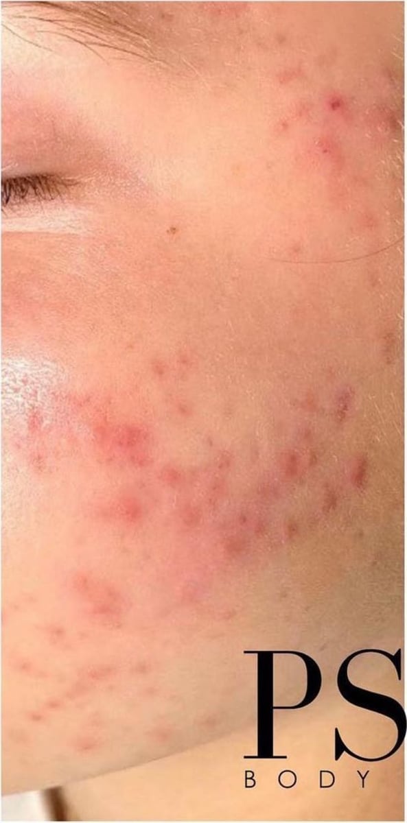Before: Acne, cheeks