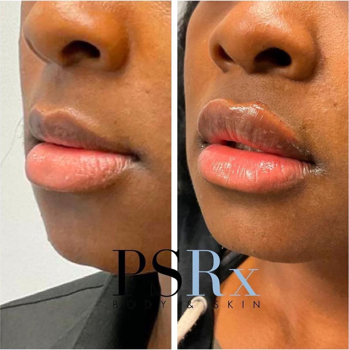 Before and after: Filler, lips