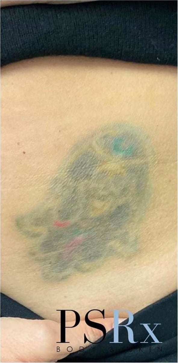 After: Tattoo removal, abdomen