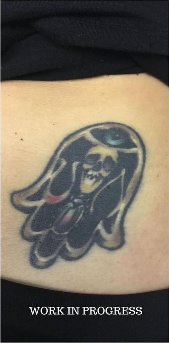 Before: Tattoo removal, abdomen