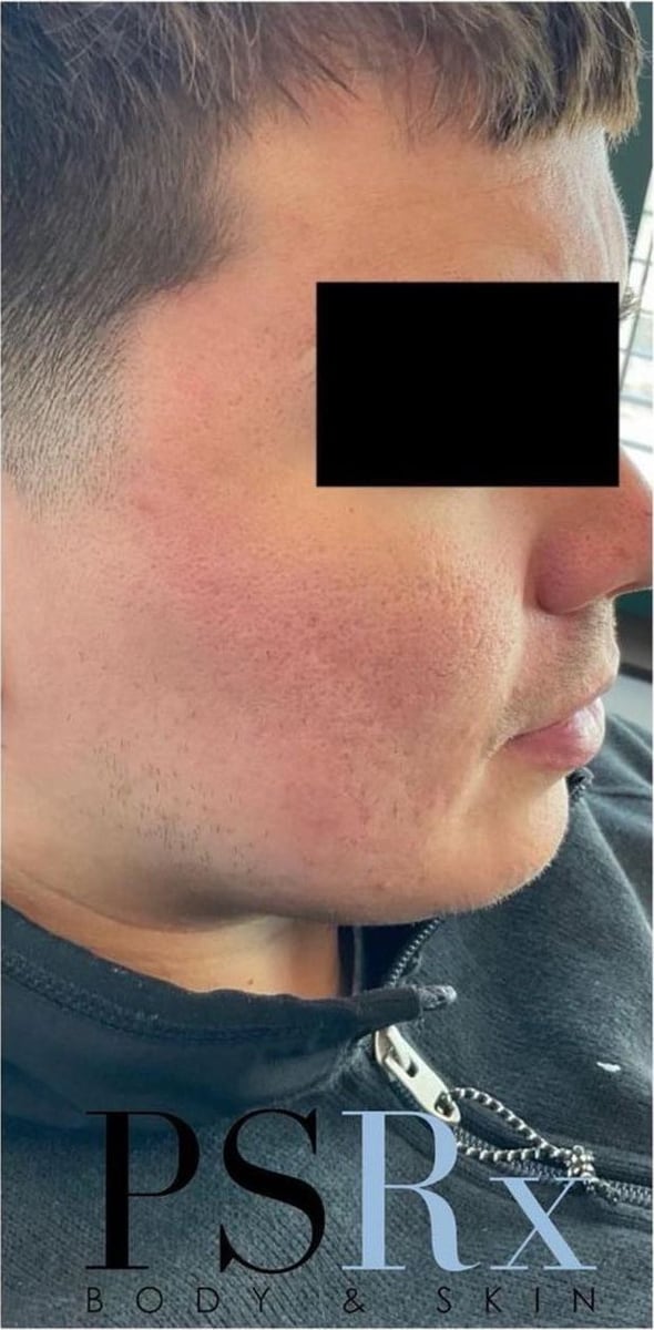 After: Scars, cheeks