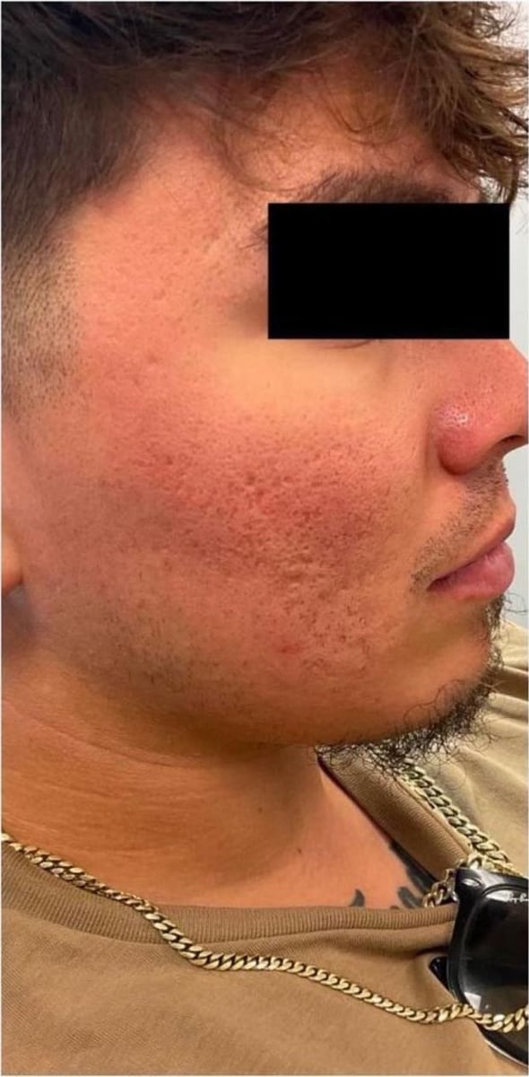 Before: Scars, cheeks