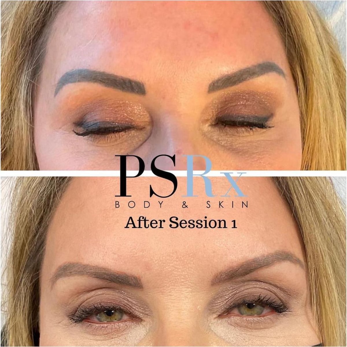 Before and after: Tattoo removal, brows