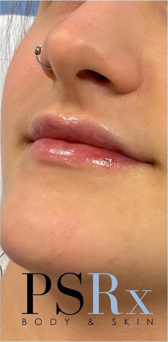 After: Filler, lips