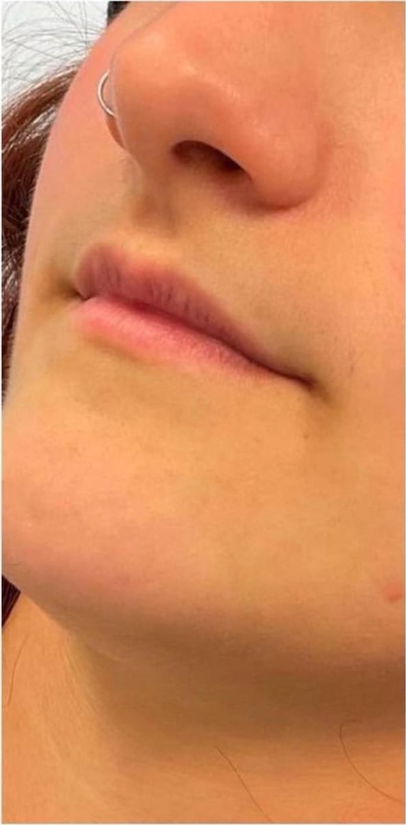 Before: Filler, lips
