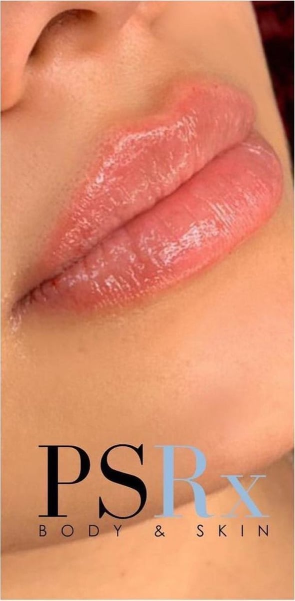 After: Filler, lips