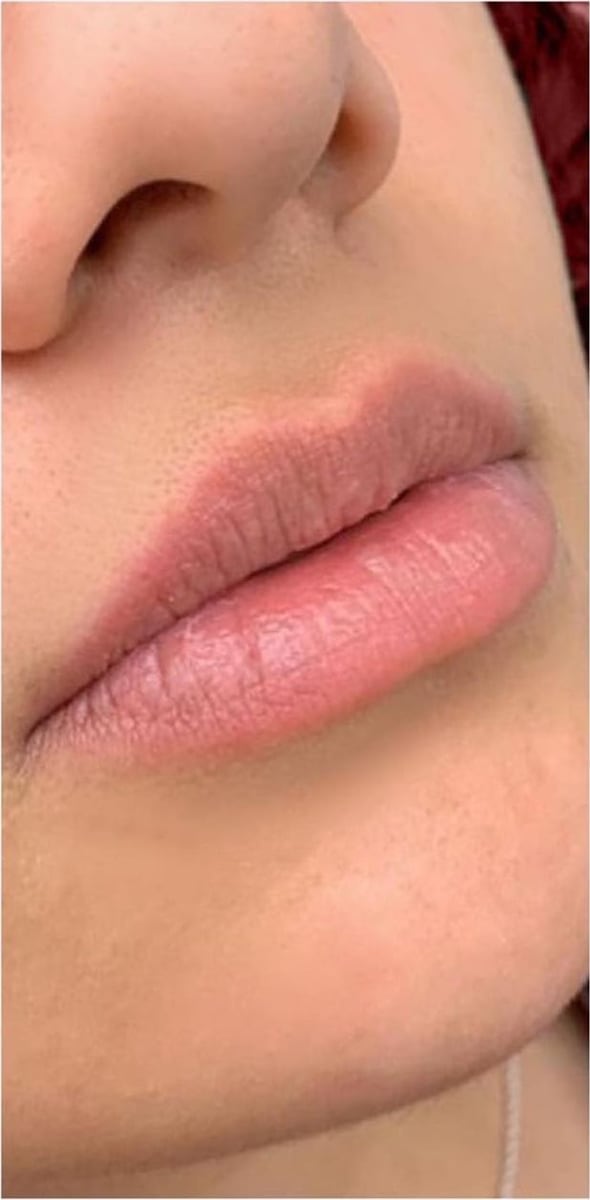 Before: Filler, lips