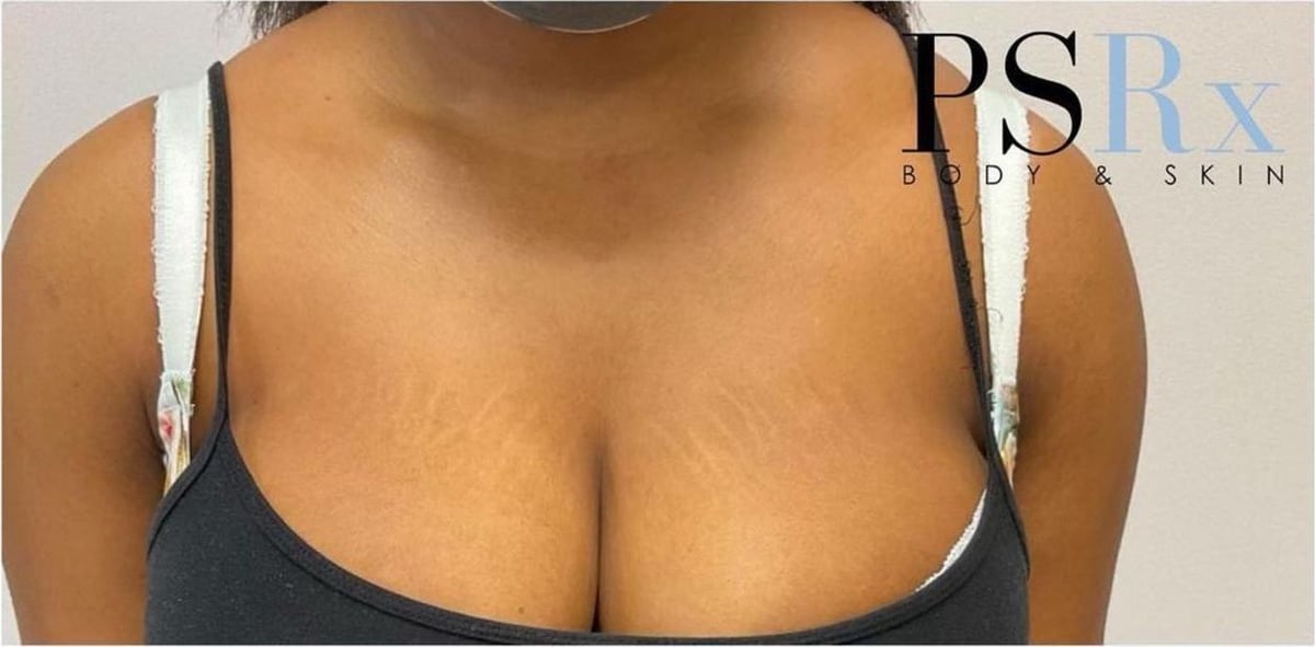 After: Stretch marks, chest