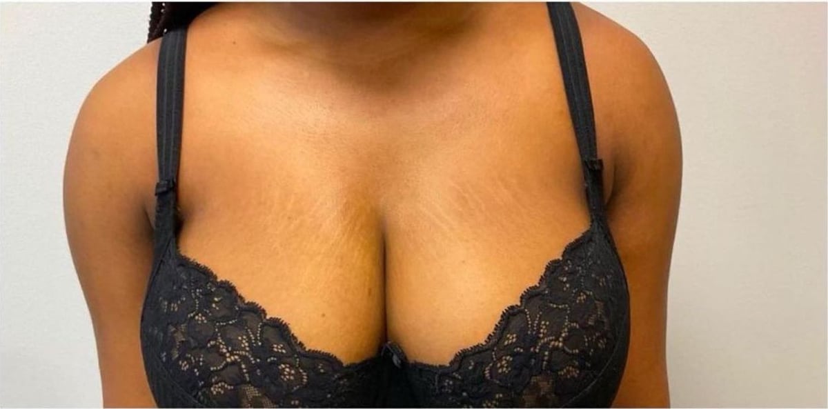 Before: Stretch marks, chest