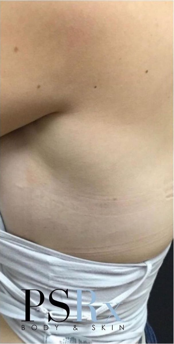 After: Tattoo removal, chest
