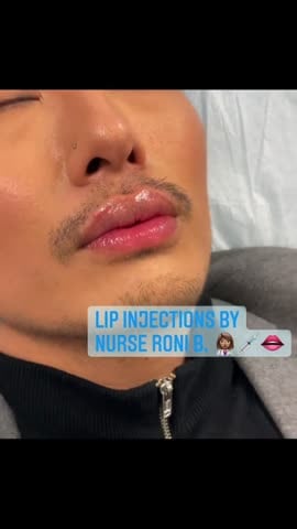 After: Filler, lips