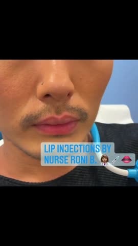 Before: Filler, lips