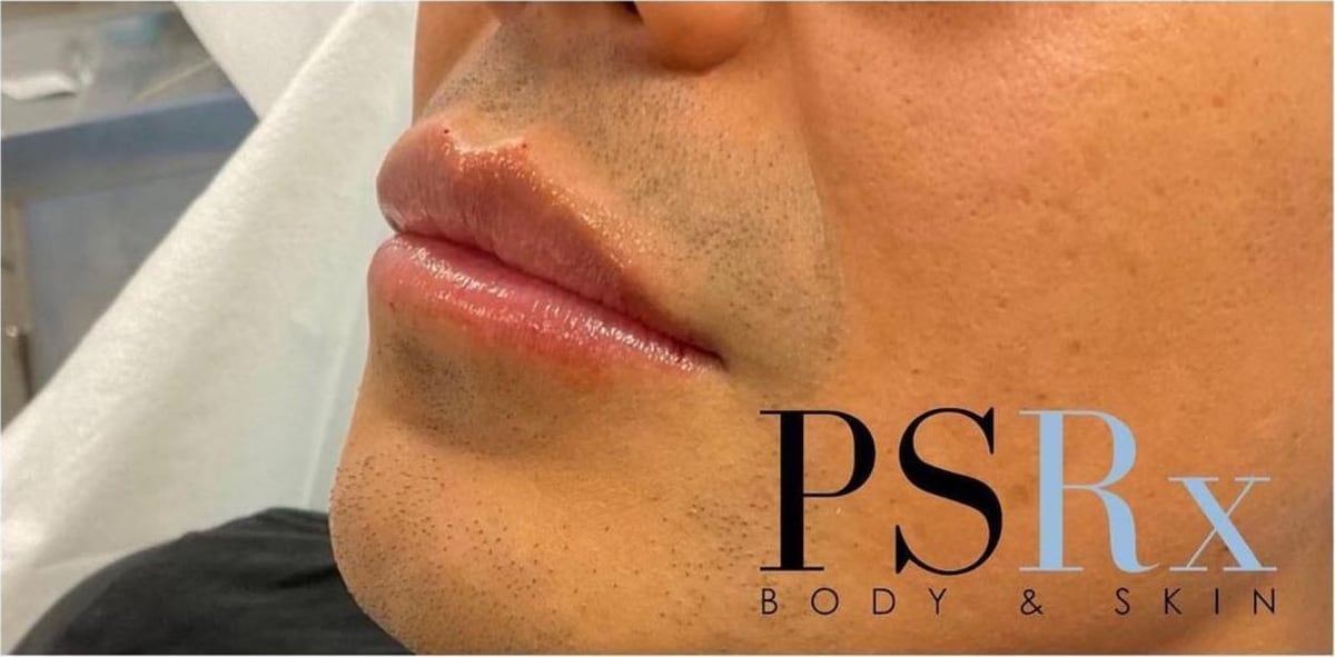 After: Filler, lips