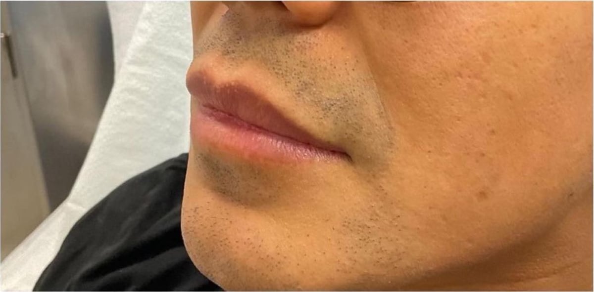 Before: Filler, lips