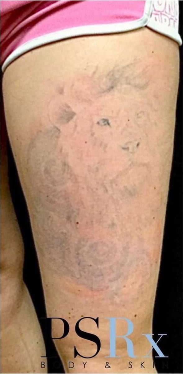After: Tattoo removal, legs