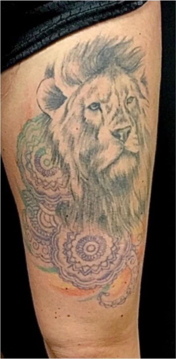 Before: Tattoo removal, legs