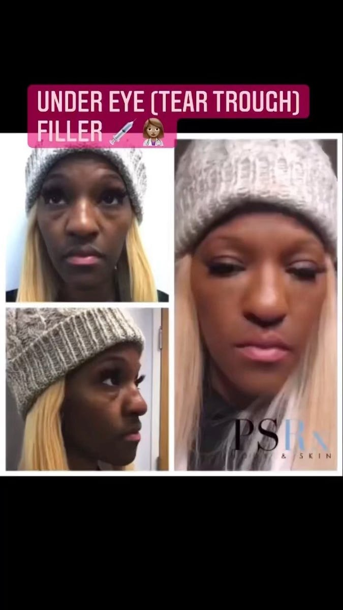 Before and after: Filler, under the eyes