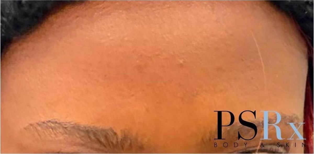 After: Neurotoxin, forehead