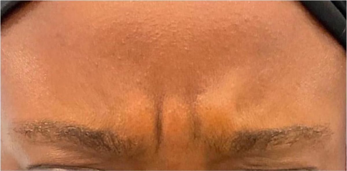 Before: Neurotoxin, forehead
