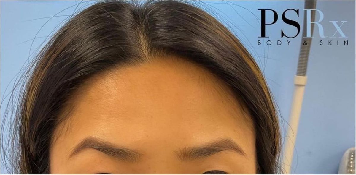 After: Neurotoxin, forehead