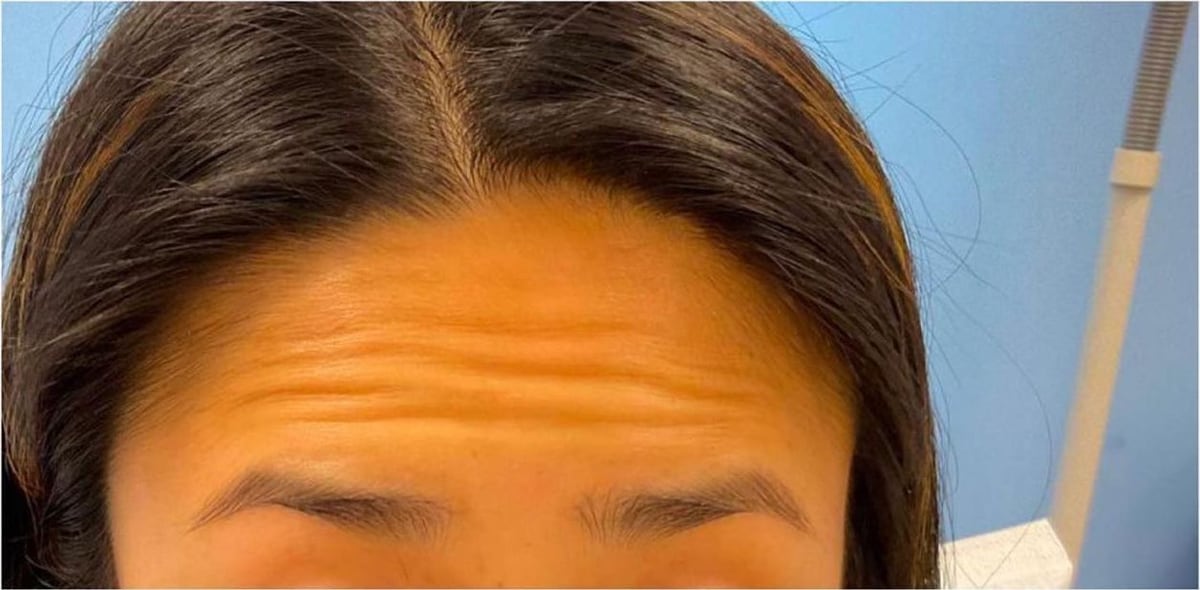 Before: Neurotoxin, forehead