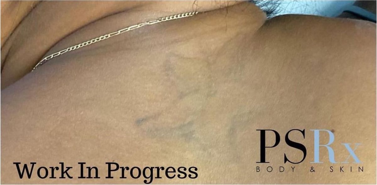 After: Tattoo removal, neck