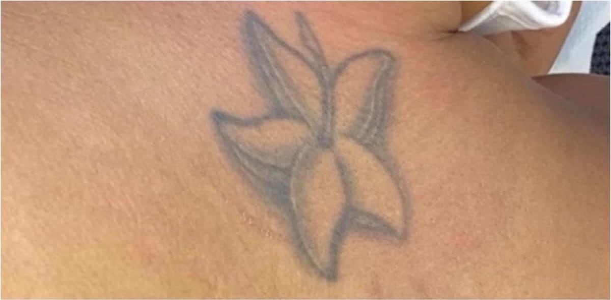 Before: Tattoo removal, neck