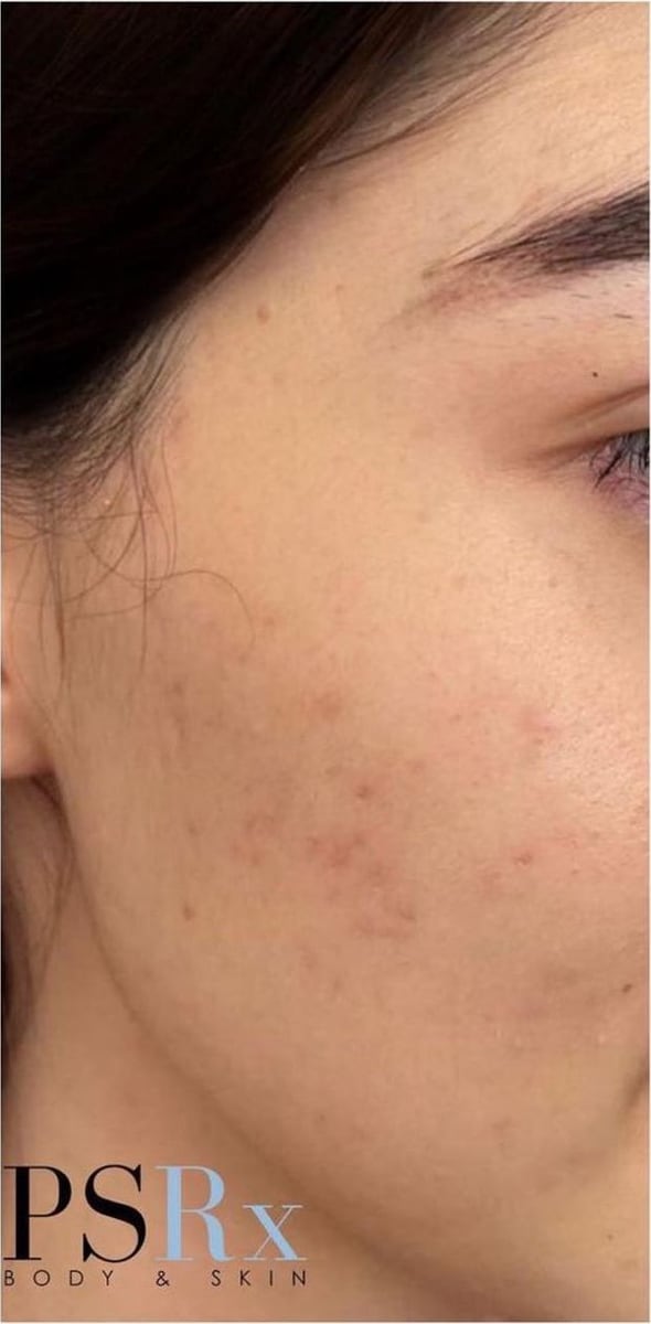 After: Acne, cheeks