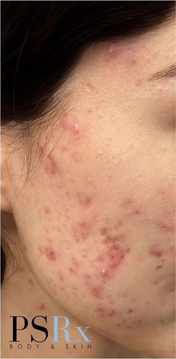 Before: Acne, cheeks
