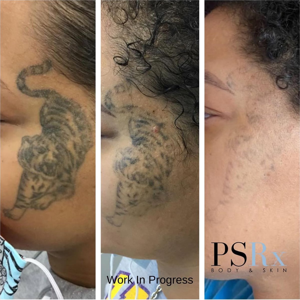 Before and after: Tattoo removal, face