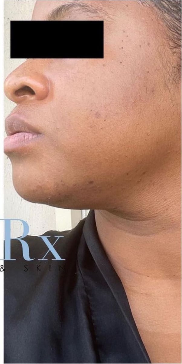 After: Dark spots, face