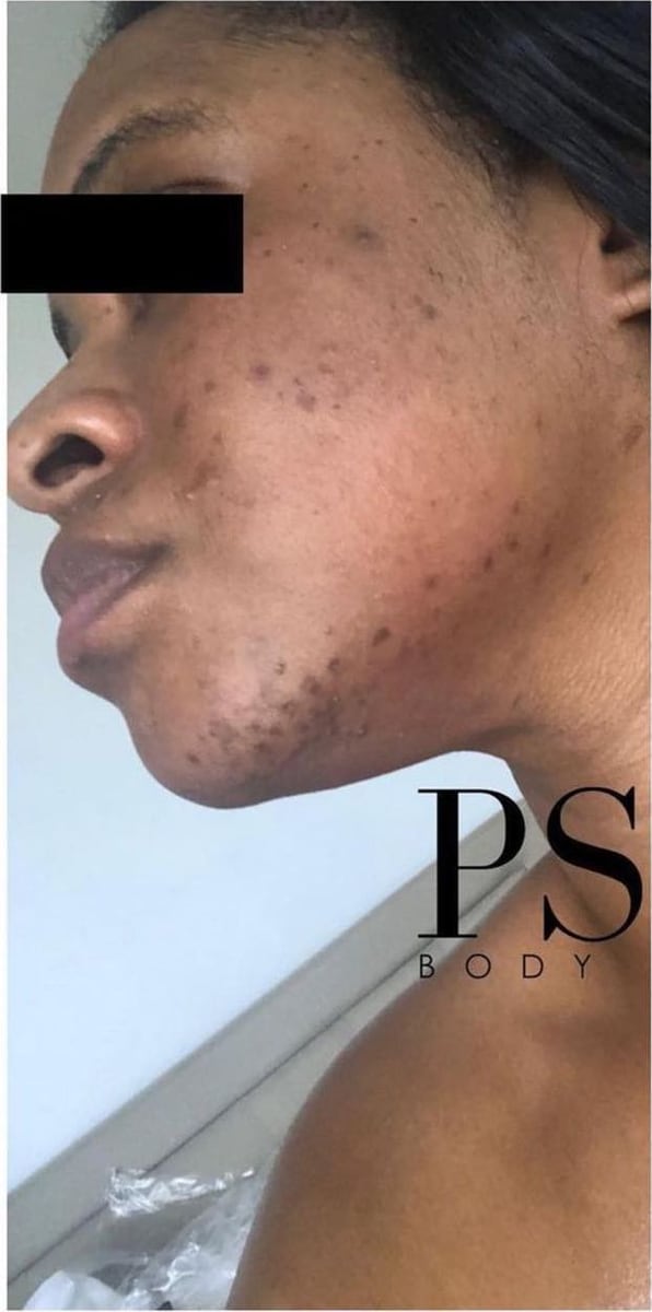 Before: Dark spots, face