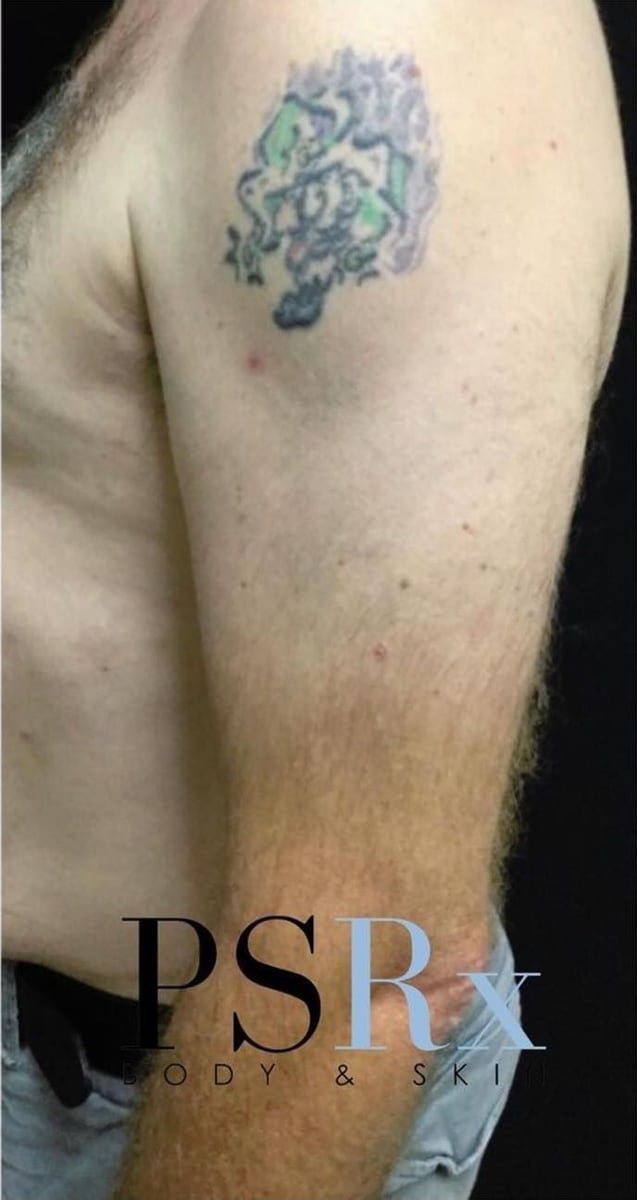 After: Tattoo removal, arm