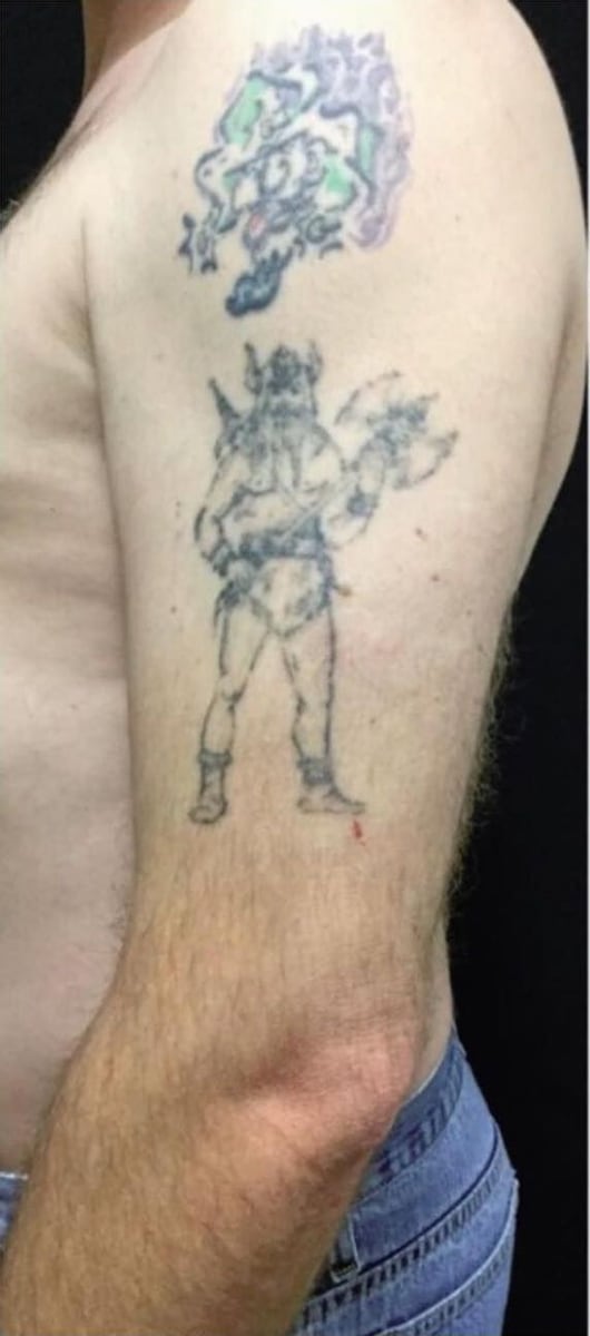 Before: Tattoo removal, arm