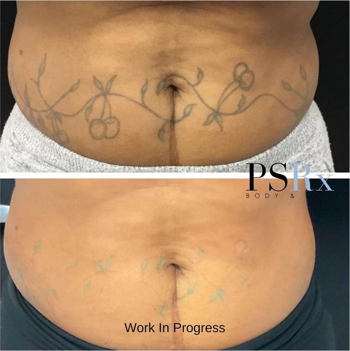 Before and after: Tattoo removal, abdomen