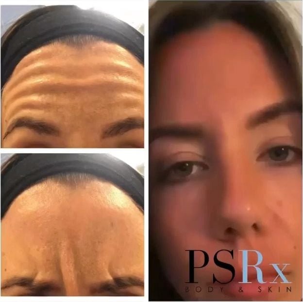 Before and after: Neurotoxin, forehead